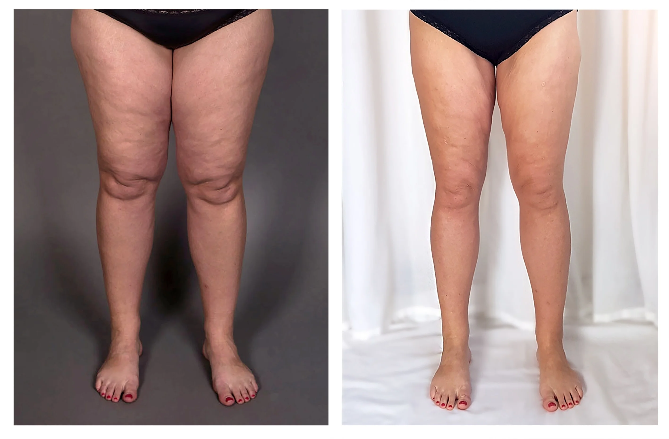 Lipedema treatment consultation and specialized care