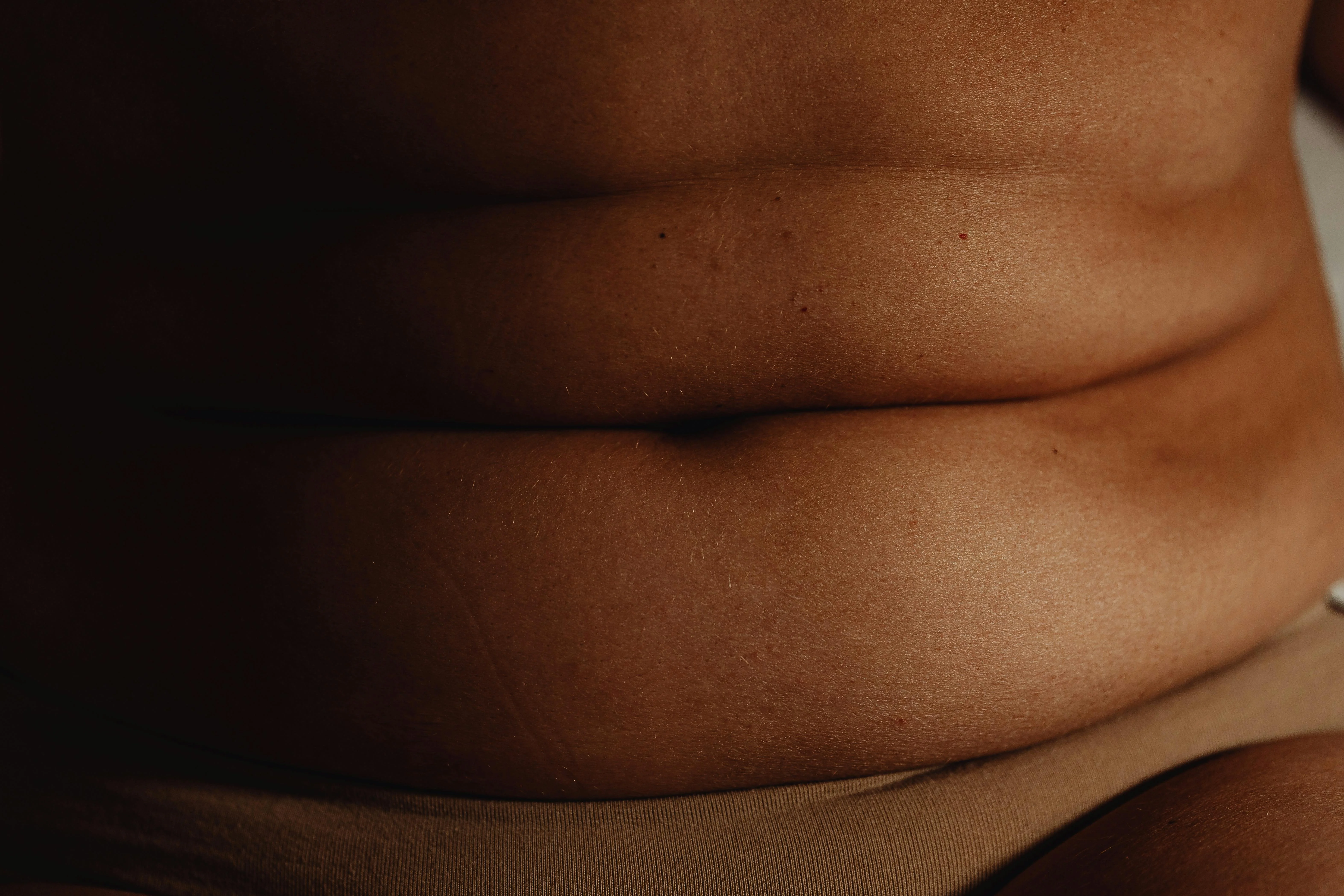 Liposuction - Professional Treatment